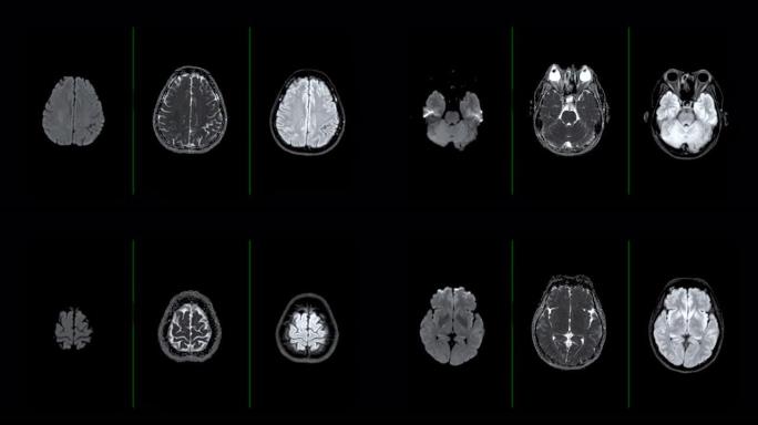 脑的磁共振成像或MRI脑用于诊断中风疾病。中风方案。
