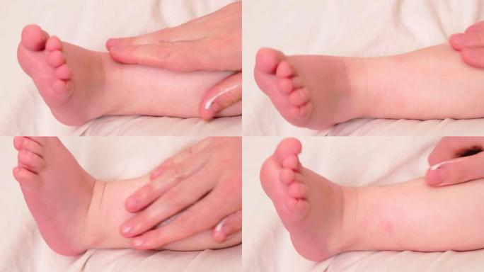 蹒跚学步的婴儿皮肤护理，过敏和皮炎。一位母亲用乳膏在儿童皮肤上涂抹过敏和特应性皮炎的红点。一岁八个月
