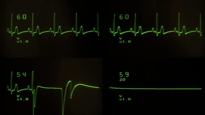 EKG屏幕特写平面-高清