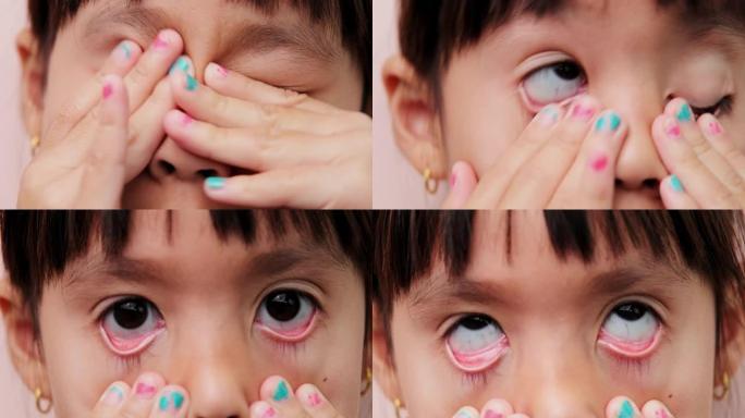 小女孩泪流满面痒，过敏揉眼睛，在户外玩耍时抓挠眼睛。