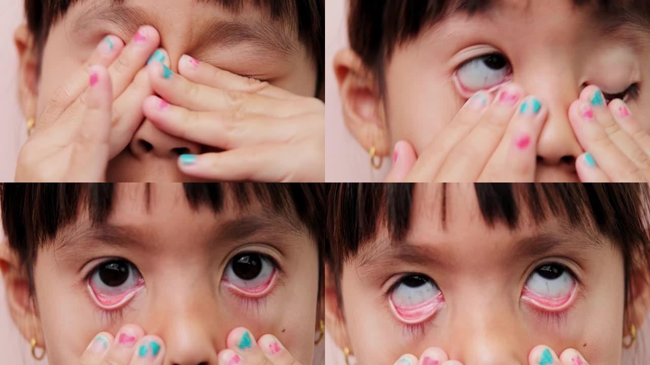 小女孩泪流满面痒，过敏揉眼睛，在户外玩耍时抓挠眼睛。