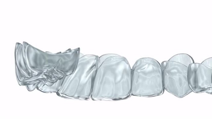 隐形支架或隐形固定器。牙科3D动画