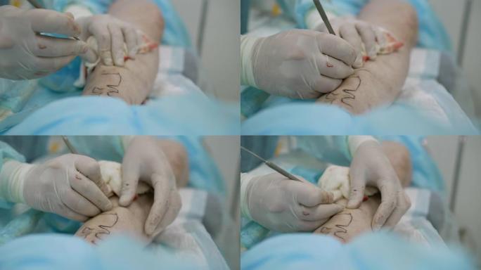 静脉曲张手术的创新方法。血管内激光凝固-外科医生使用在患者皮肤下发光的激光去除静脉曲张。