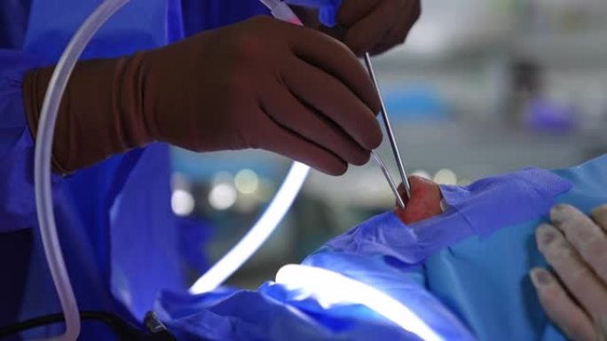 外科医生戴着手套的手将仪器输入鼻腔。鼻整形术用于呼吸恢复。特写。