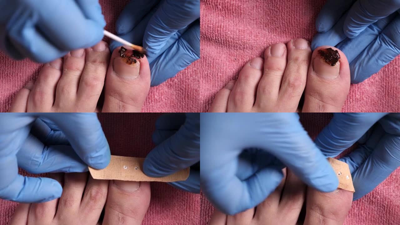 一种药膏被涂在受真菌影响的指甲上。用蜂胶治疗指甲真菌。