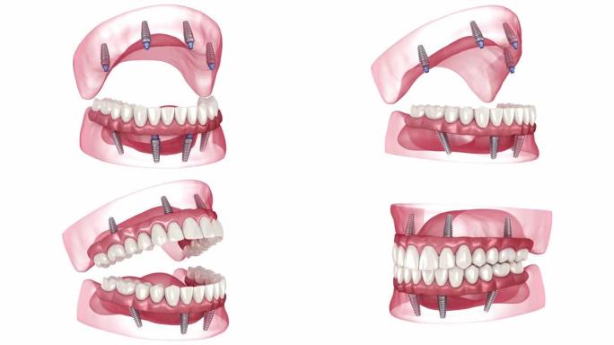 由8个植入物支撑的假体。牙科3D动画