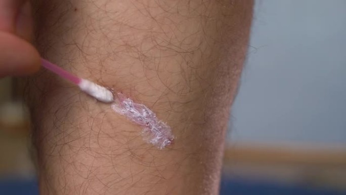男性腿部血肿的治疗，在划痕皮肤上涂抹