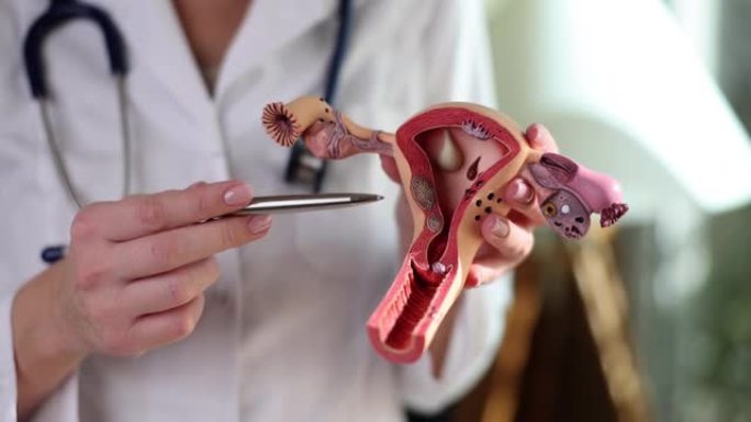妇科医生持有女性生殖器官解剖模型