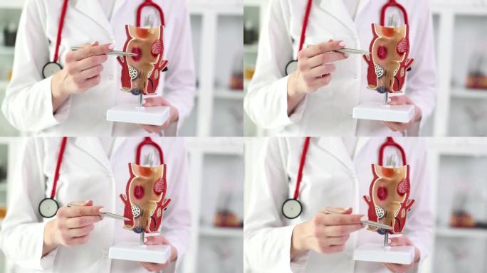 医学教授在人体器官人工模型上显示直肠疾病特写4k电影慢动作