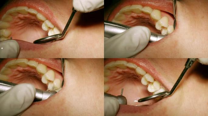 牙医钻洞并清除洞深