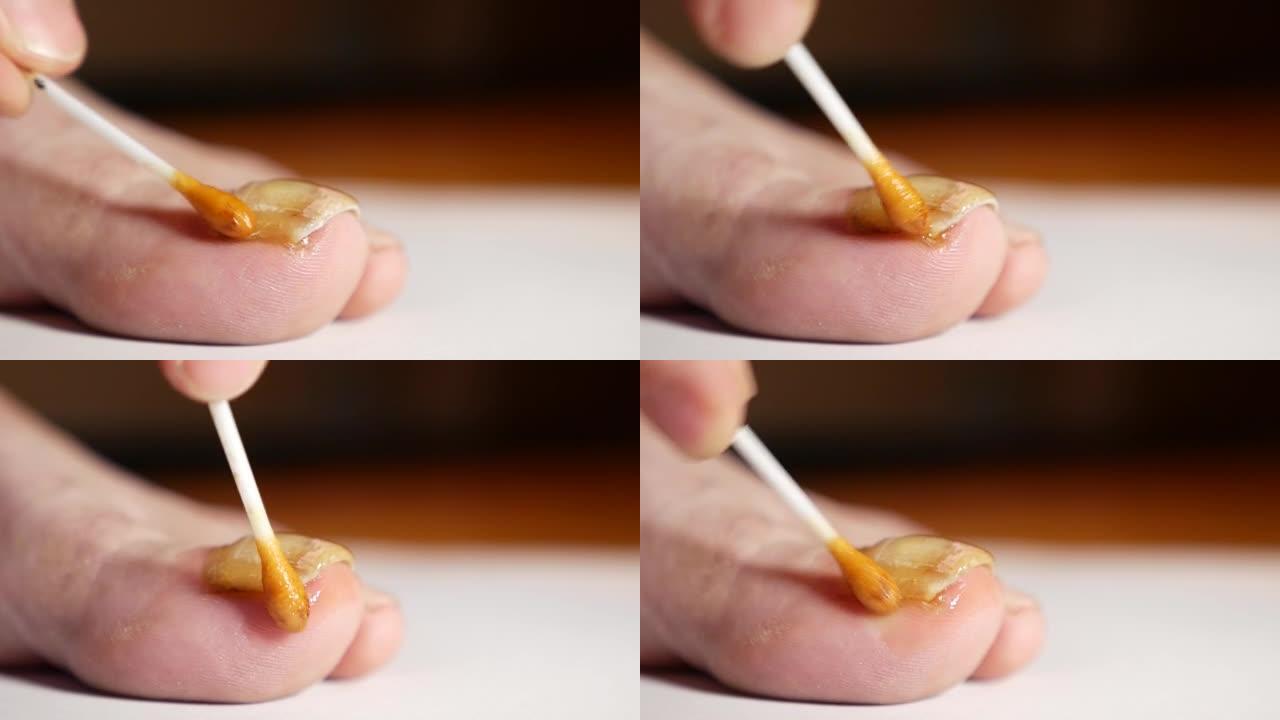 将蜂胶溶液涂在受真菌影响的指甲上。指甲真菌治疗的非常规方法。