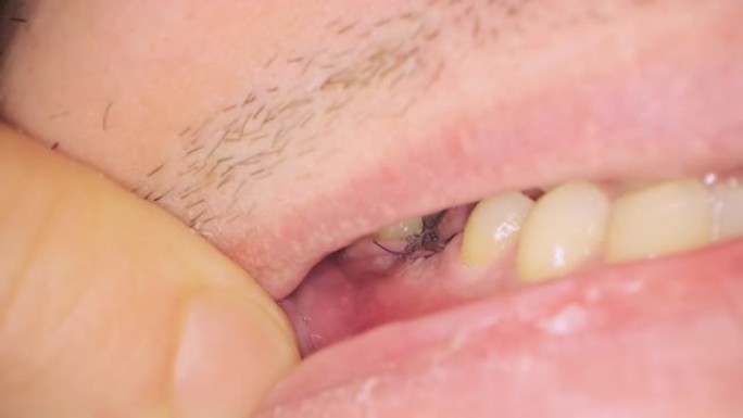 临床上植入牙齿后在牙龈上贴上黑线