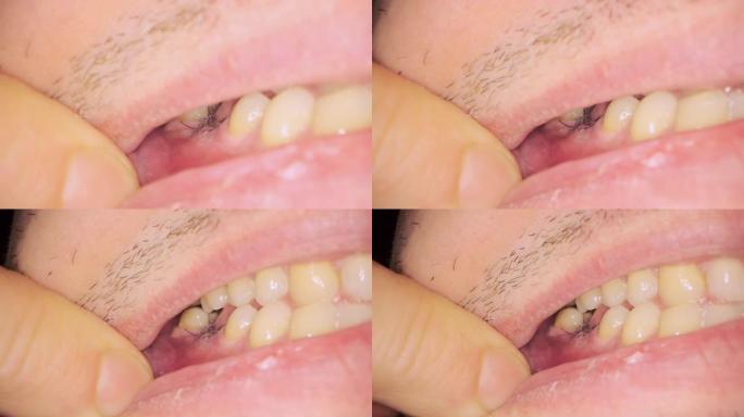 临床上植入牙齿后在牙龈上贴上黑线