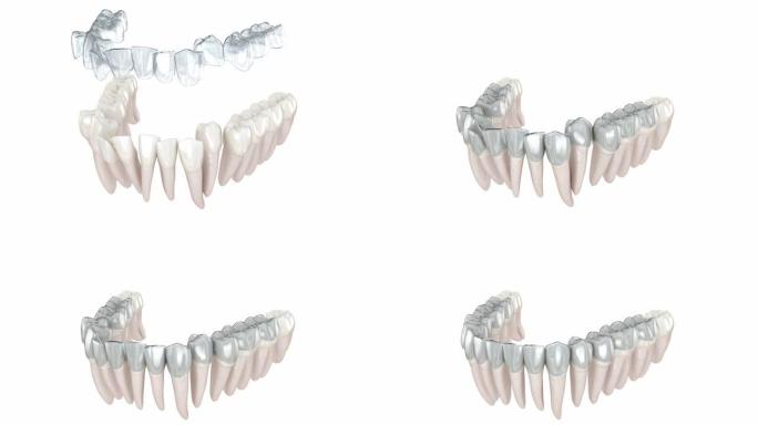 隐形支架或隐形固定器进行咬合校正。3D动画