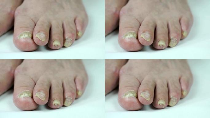 女人的脚有脚趾甲的真菌感染