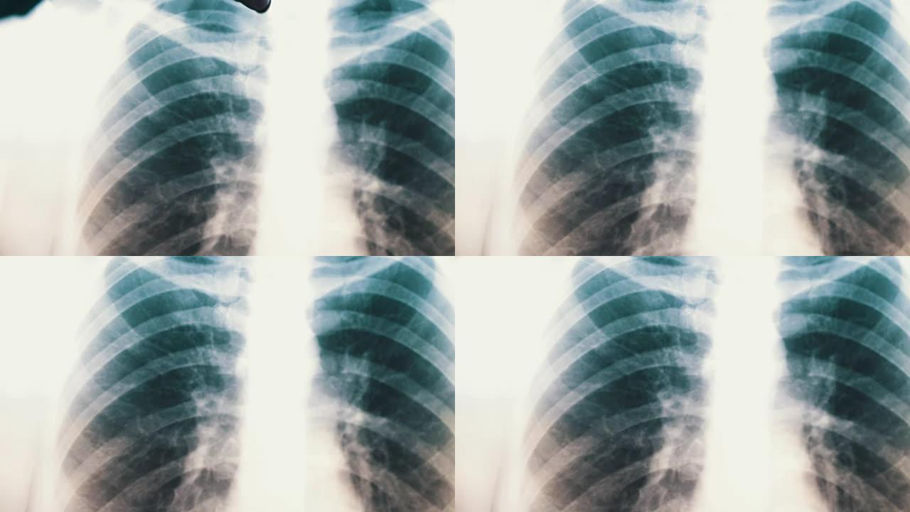 人肺的x射线。预防肺癌的诊断。