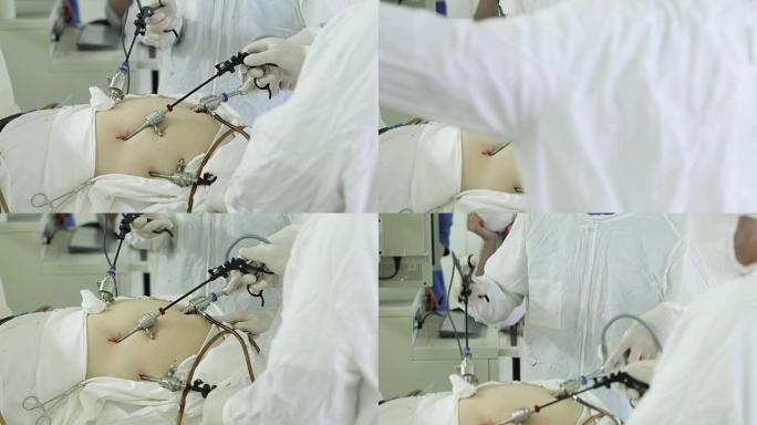 4k医疗专家团队进行了腹腔镜手术。