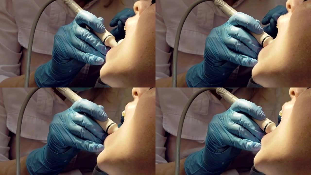 女性超声波牙菌斑牙本质去除
