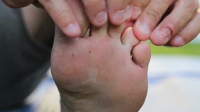 男子发现脚尖发痒的运动员脚在脚趾上生长
