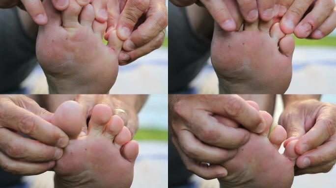 男子发现脚尖发痒的运动员脚在脚趾上生长