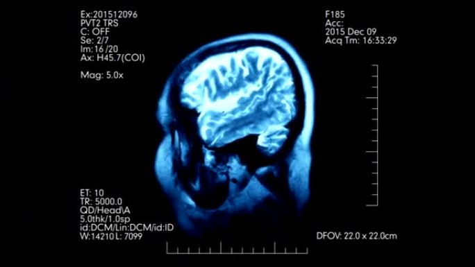 具有医学数据的MRI脑部扫描轮廓动画