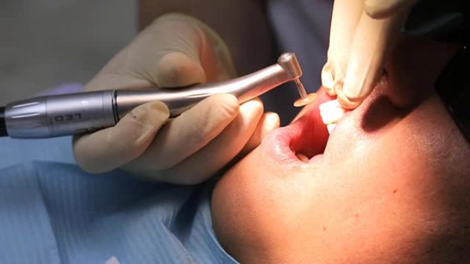 患者口腔中借助椎间盘手柄完成牙釉质的斜面