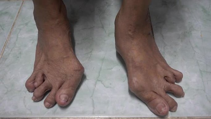 老妇人的脚因类风湿或痛风性关节炎而变形