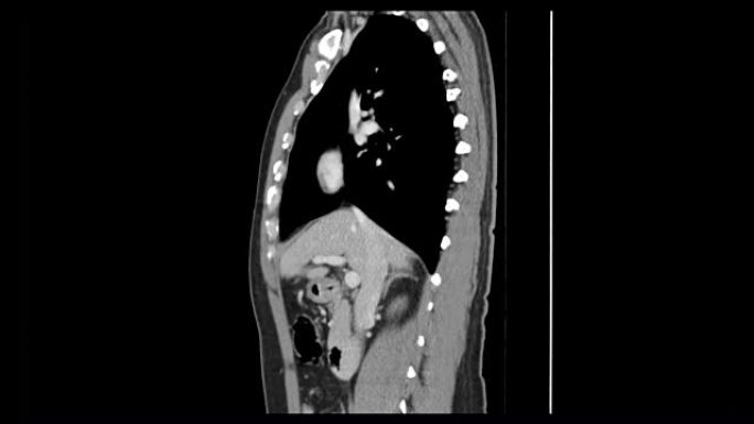 腹部侧视ct扫描