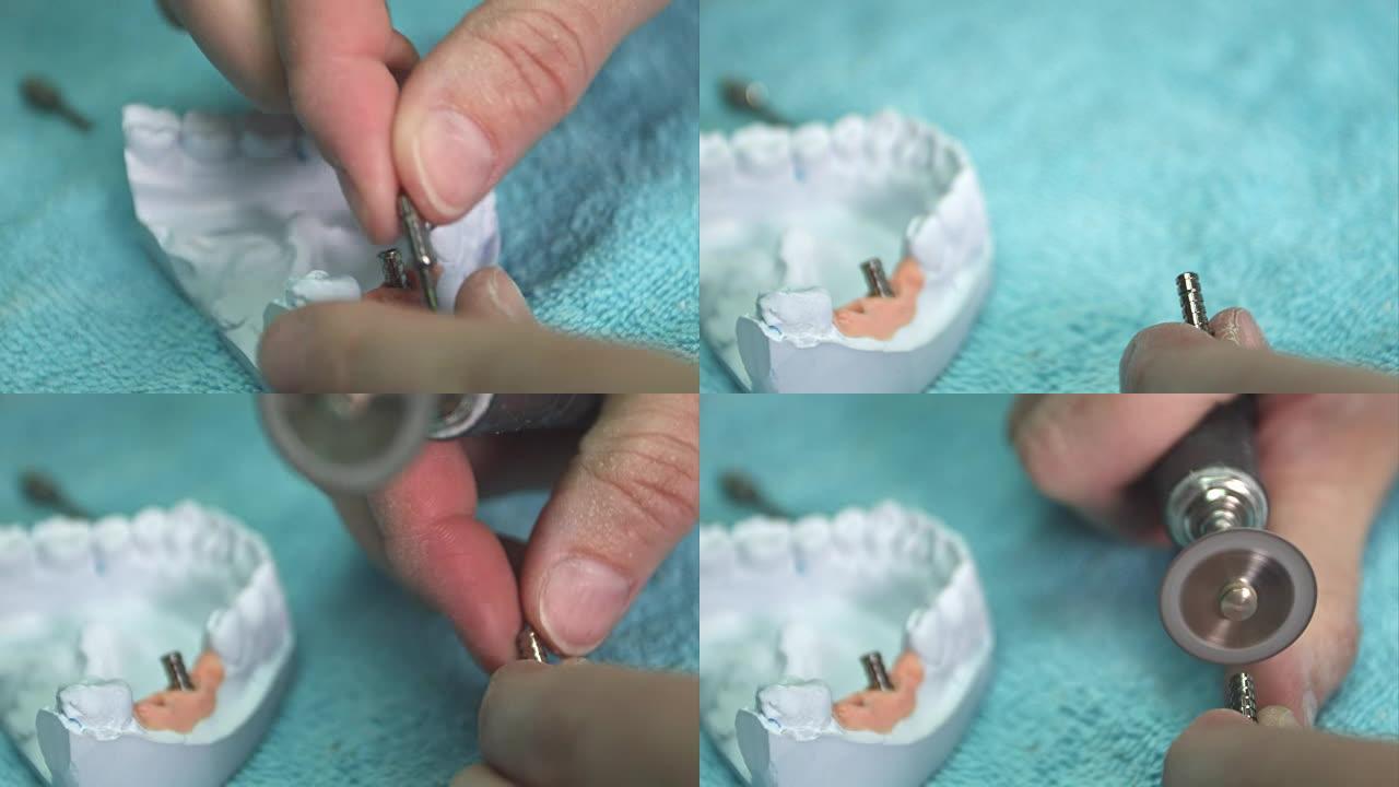 牙医展示了带有植入物的假牙模型