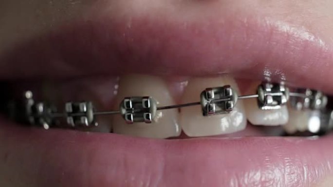 牙齿上的牙套特写。牙齿上有牙套的女孩。