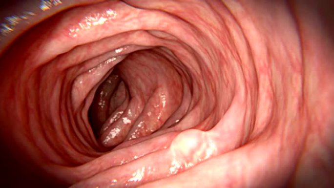 肠内生长的息肉。胃肠镜检查胃息肉肠息肉
