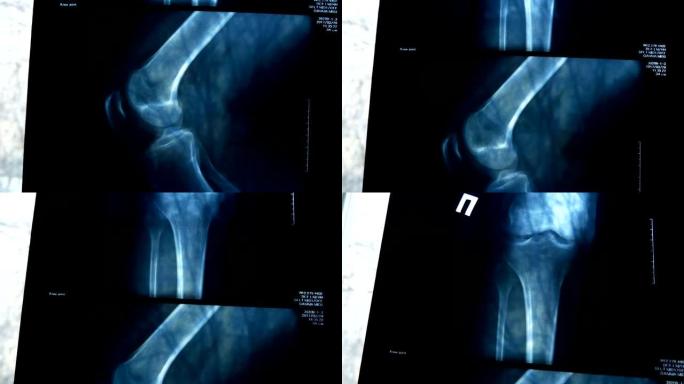 X射线照片显示膝关节并关节病