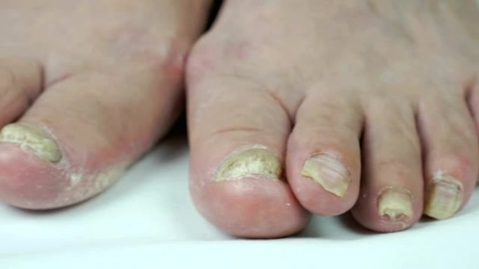 真菌感染人脚指甲