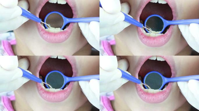 牙医清洁牙齿和使用牙菌斑去除工具检查的镜头特写