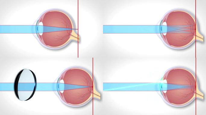 晶状体矫正各种眼视力障碍