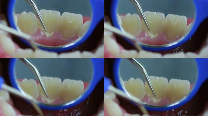 牙医清洁牙齿和使用牙菌斑去除工具检查的镜头特写