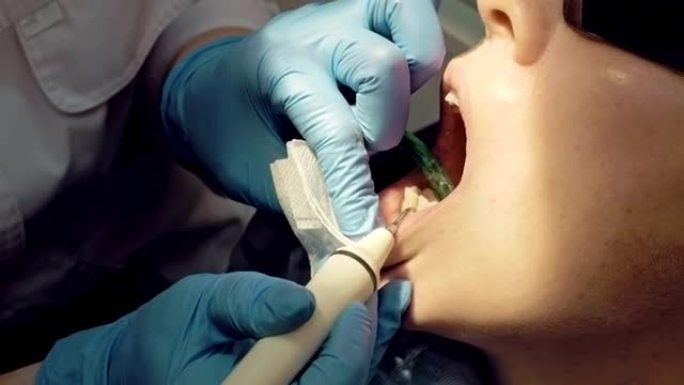 女性超声波牙菌斑牙本质去除