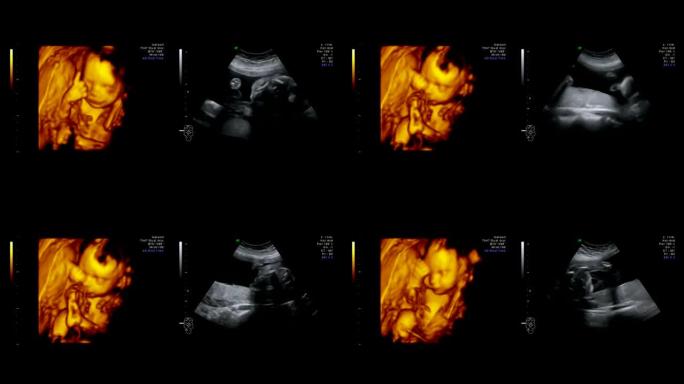 胎儿超声图像