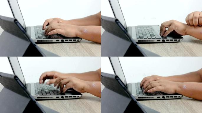 男人的手使用笔记本电脑并抓挠皮肤皮疹牛皮癣