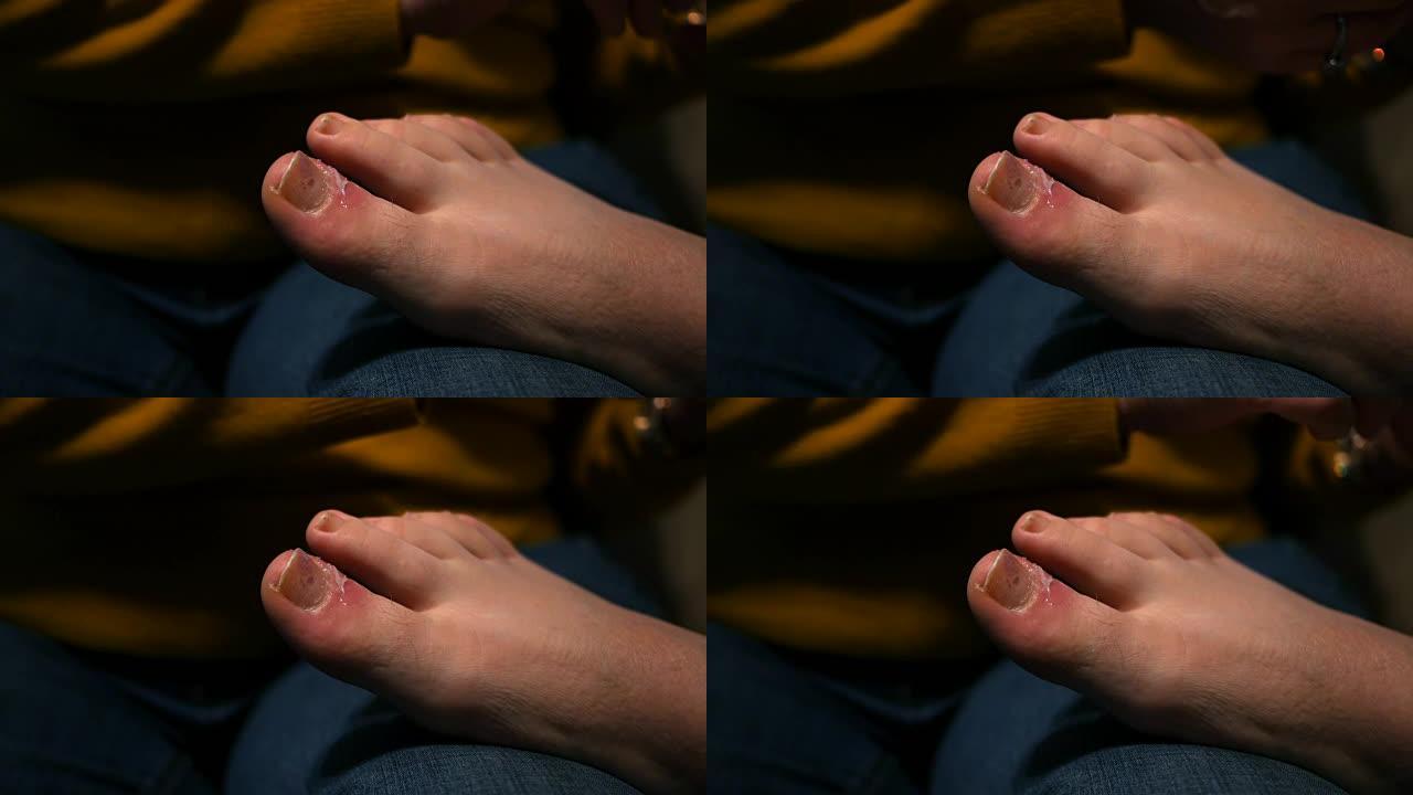红色发炎的脚趾的特写