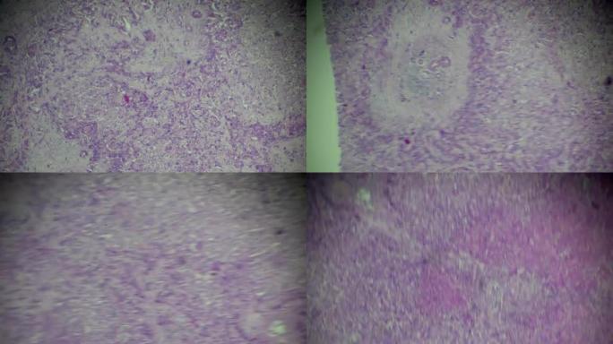 肝细胞癌，肝细胞癌镜下