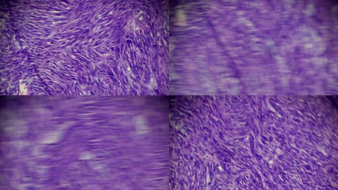 光学显微镜下平滑肌瘤 (子宫) 活检样本在不同区域的放大