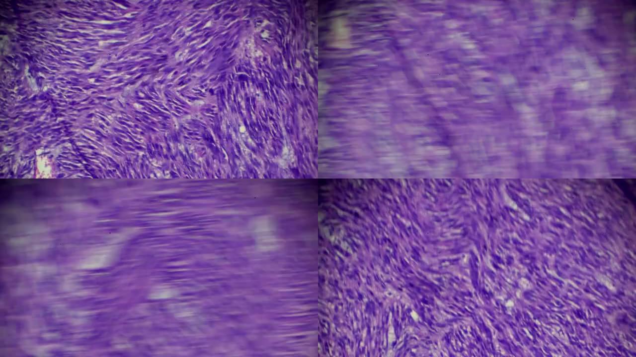 光学显微镜下平滑肌瘤 (子宫) 活检样本在不同区域的放大