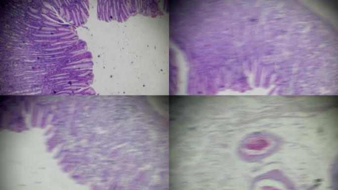 胃黏膜肠上皮化生镜下