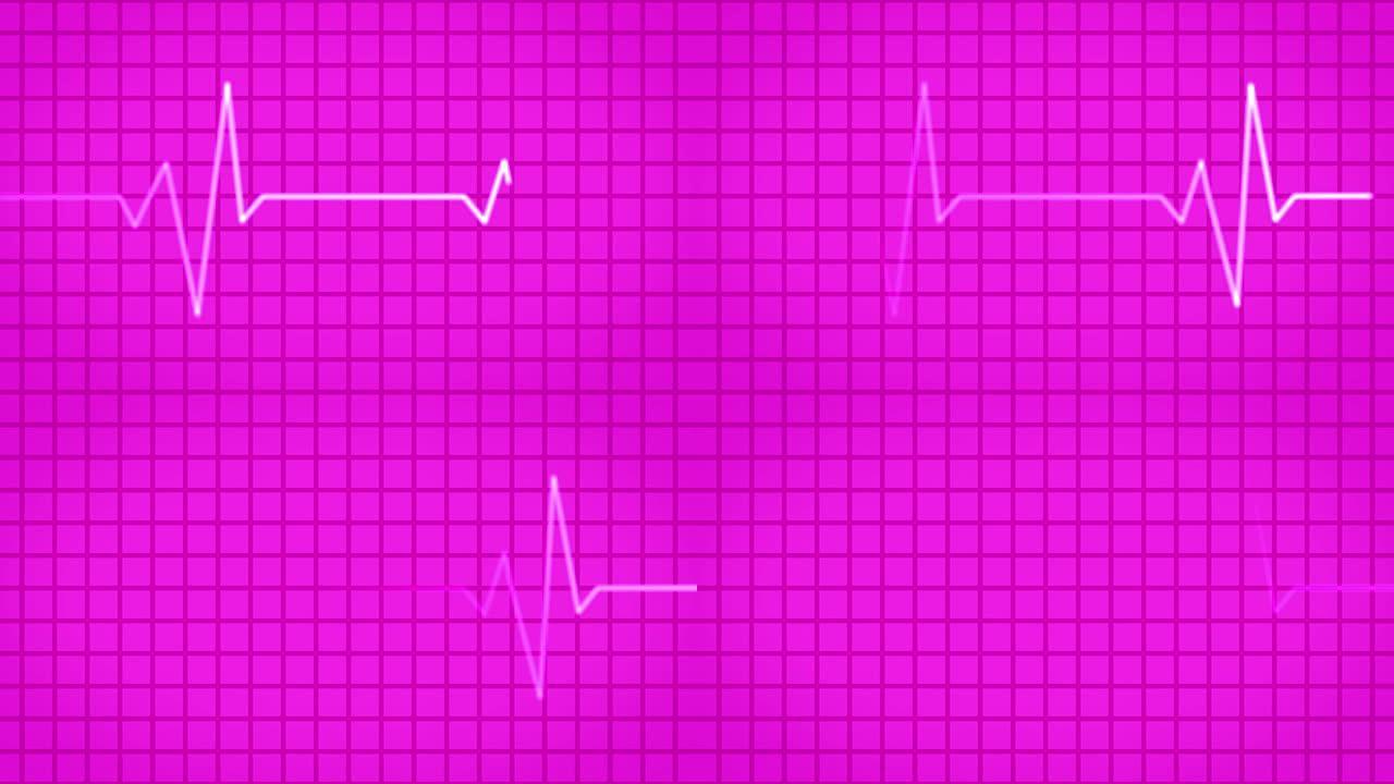 心电图 (EKG或ECG) loop pink