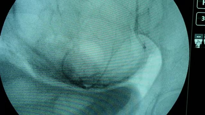 X射线设备的圆形蓝屏检查带有动脉的女性乳房