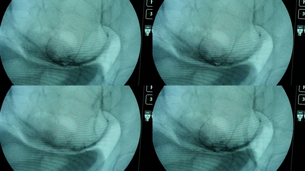 X射线设备的圆形蓝屏检查带有动脉的女性乳房