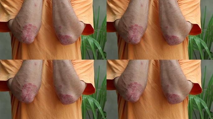 牛皮癣。皮肤发红，发痒，鳞片。肘部鳞片或结皮的斑块