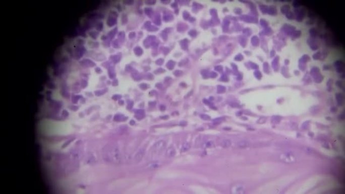 显微镜下鳞状细胞癌，不同区域和