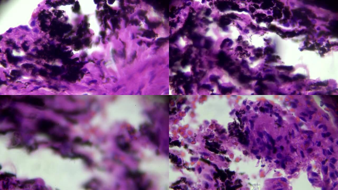 显微镜下有黑色沉积物的烟肺